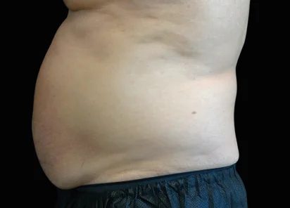 EMSCULPT NEO before and after, published example, Square Mile Clinic, City of London EMSCULPT NEO before treatment example, published by BTL, for EMSCULPT NEO at Square Mile Clinic, London