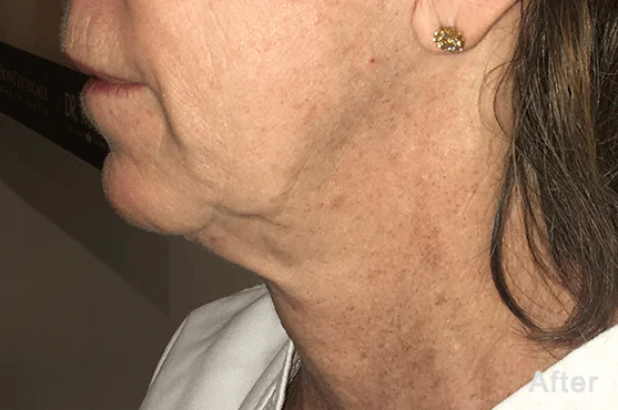 Morpheus8 before and after, published example, Square Mile Clinic, City of London After Morpheus8 treatment of the neck and lower face, case by Dr. F Roth, Morpheus8 at Square Mile Clinic