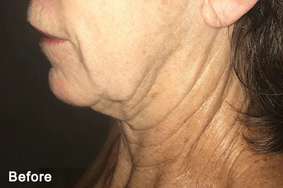 Morpheus8 before and after, published example, Square Mile Clinic, City of London Before Morpheus8 treatment of the neck and lower face, case by Dr. F Roth, Morpheus8 at Square Mile Clinic
