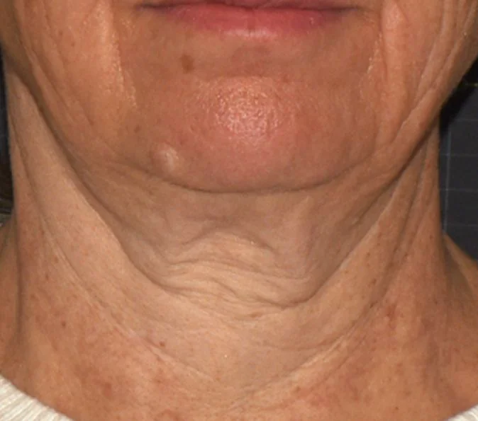 Sofwave before and after, published example, Square Mile Clinic, City of London Before Sofwave neck procedure by Suzanne Kilmer, published example, Sofwave at Square Mile Clinic, London